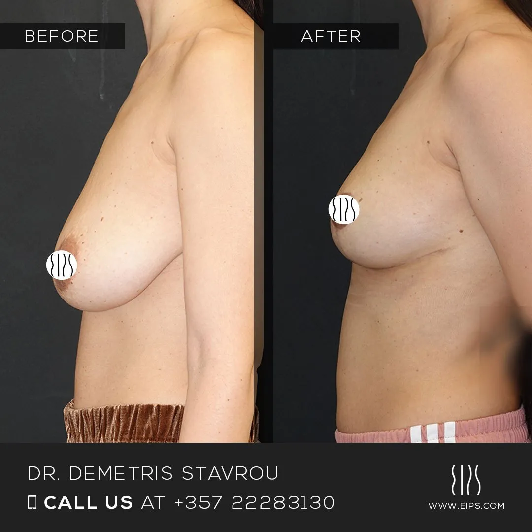Breast Reduction before and after
