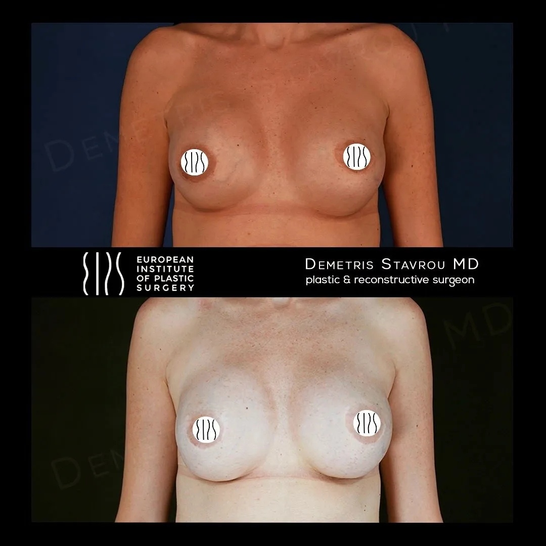 Breast Revision Surgery before and after