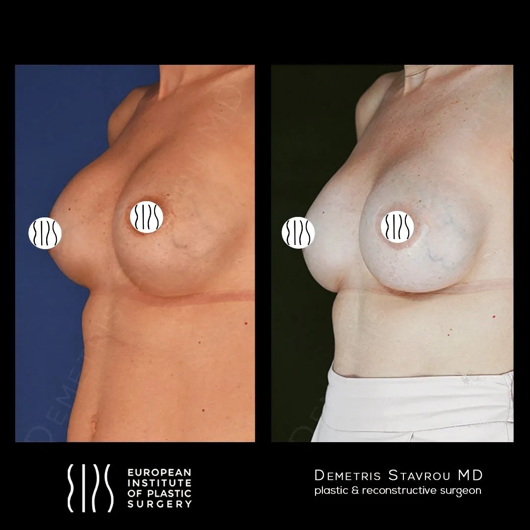 Breast Revision Surgery before and after