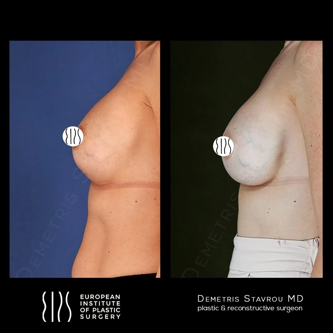 Breast Revision Surgery before and after