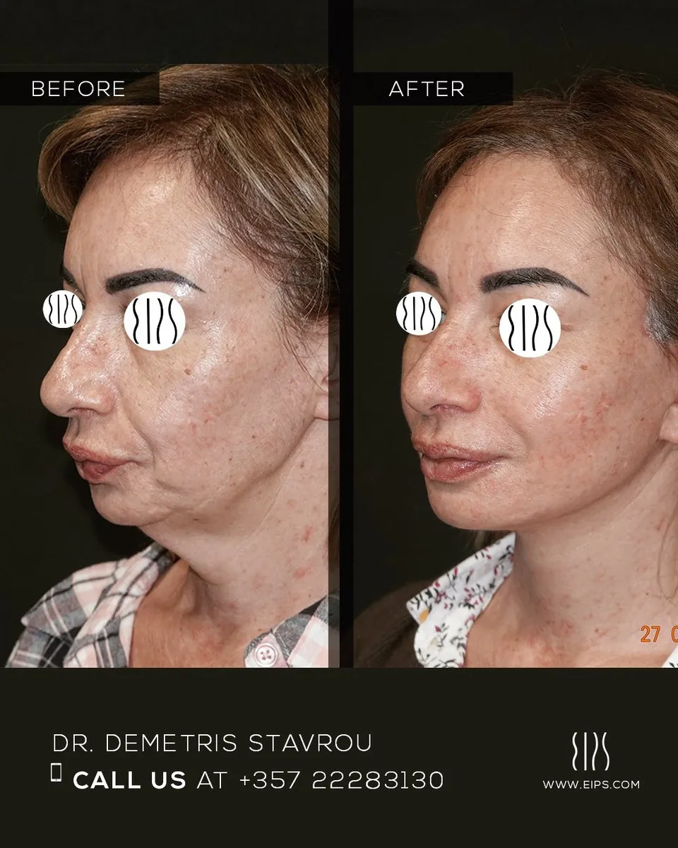 Facelift before and after