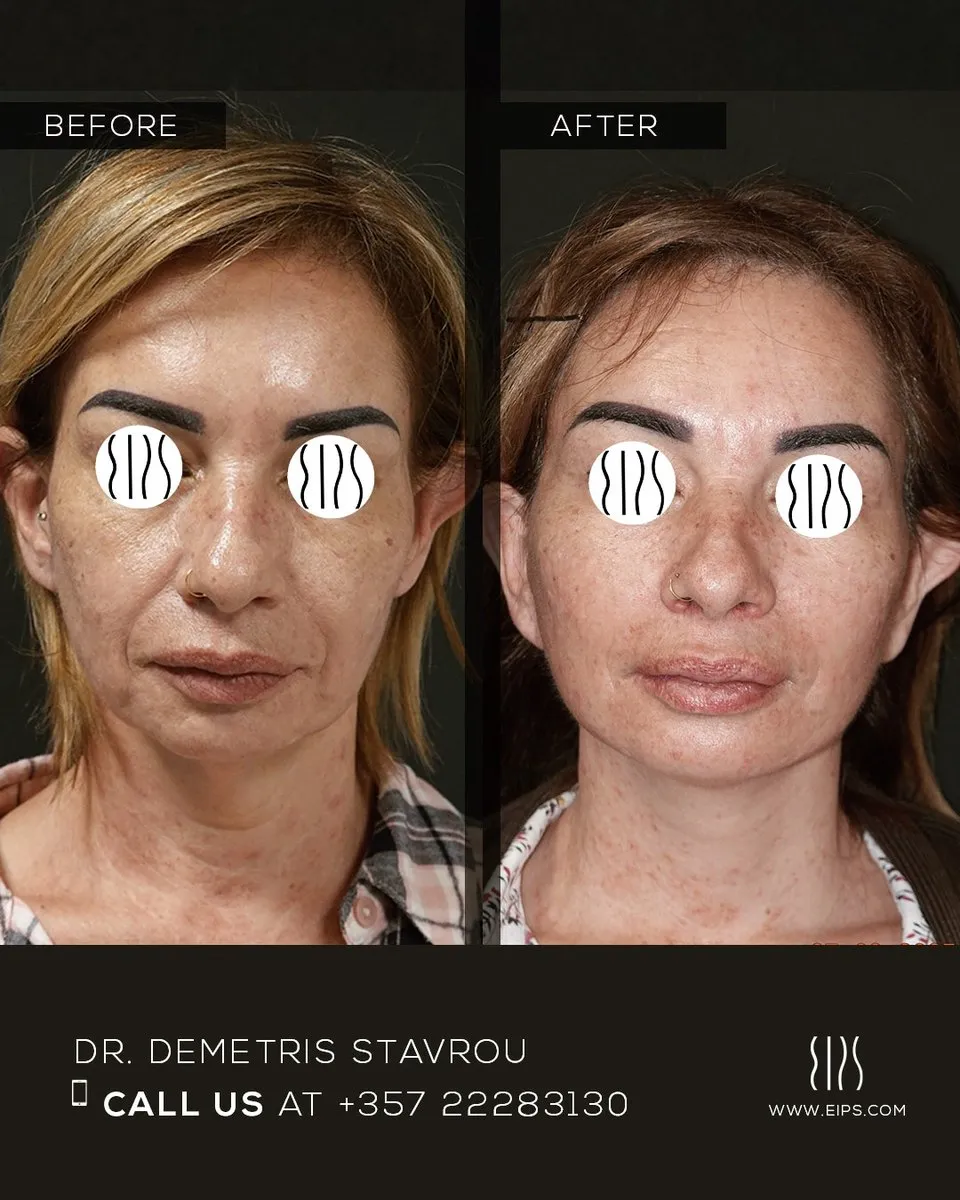 Facelift before and after