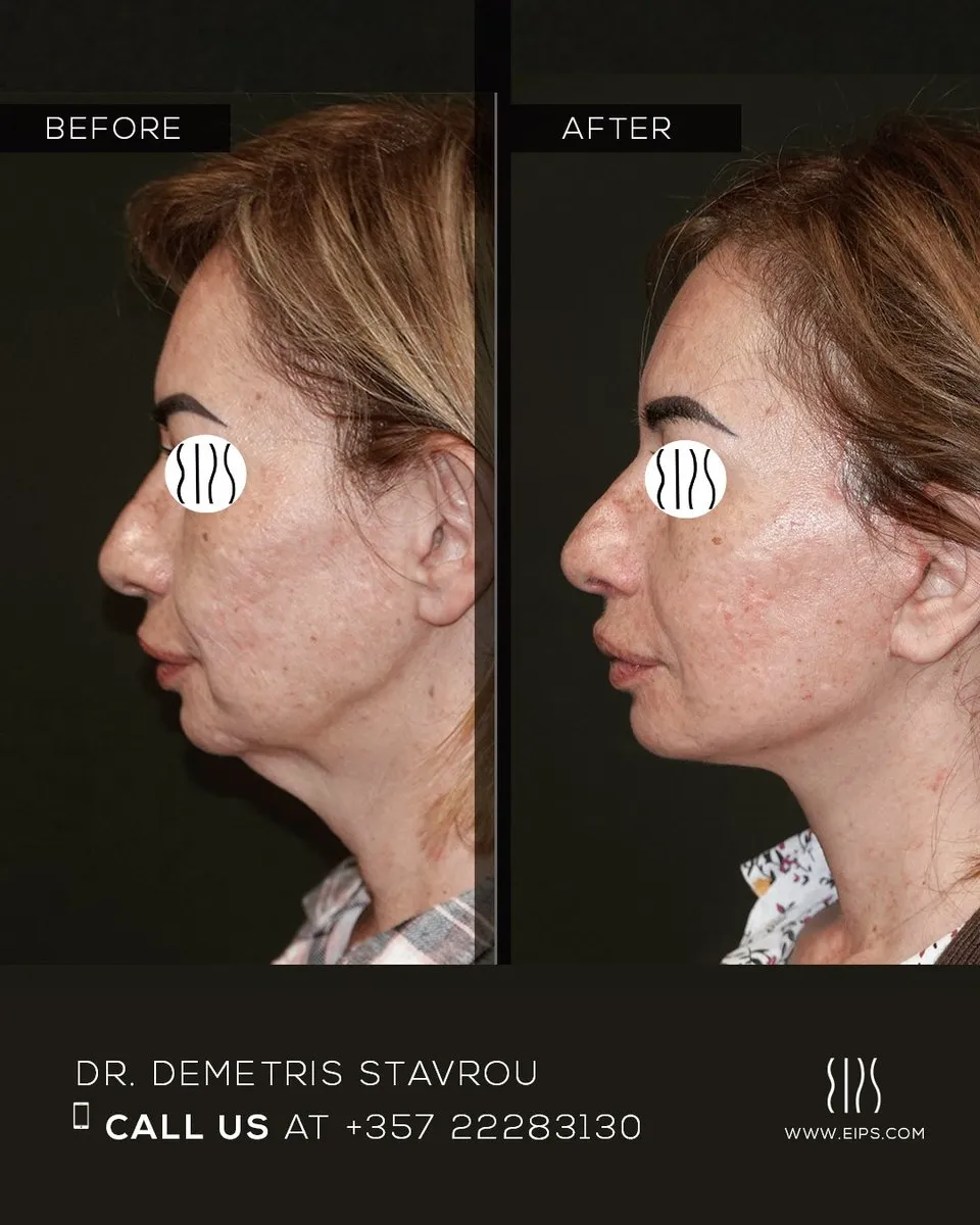 Facelift before and after