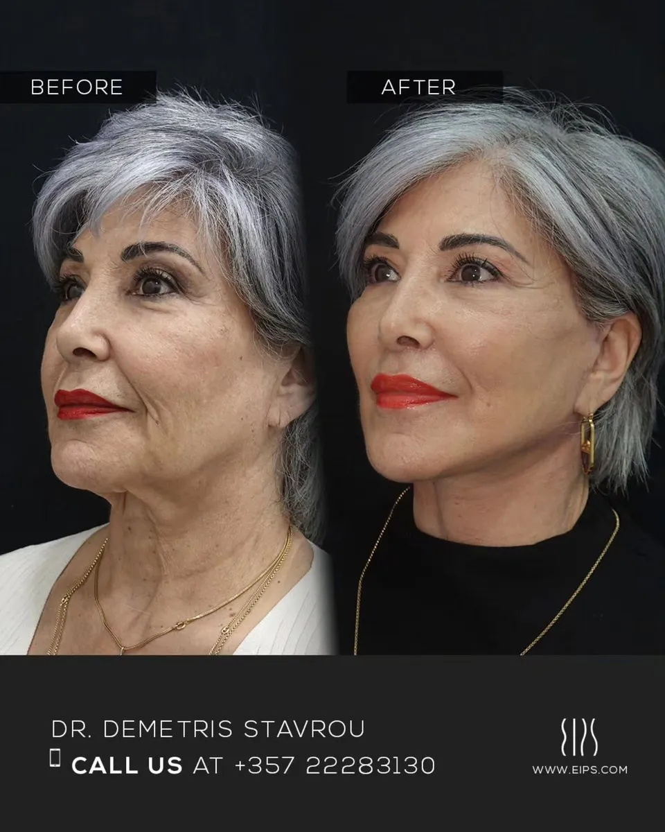 Facelift before and after