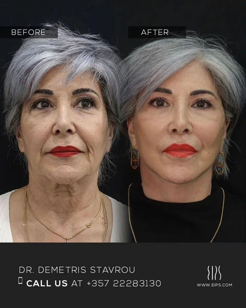 Facelift before and after