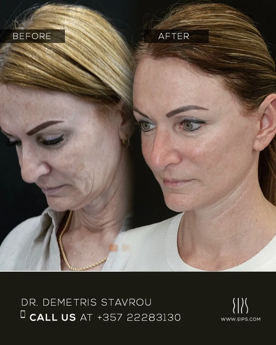 Facelift before and after