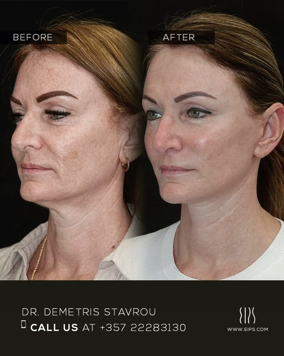Facelift before and after