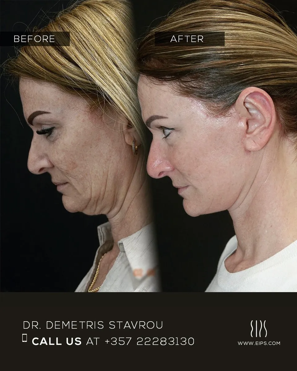 Facelift before and after