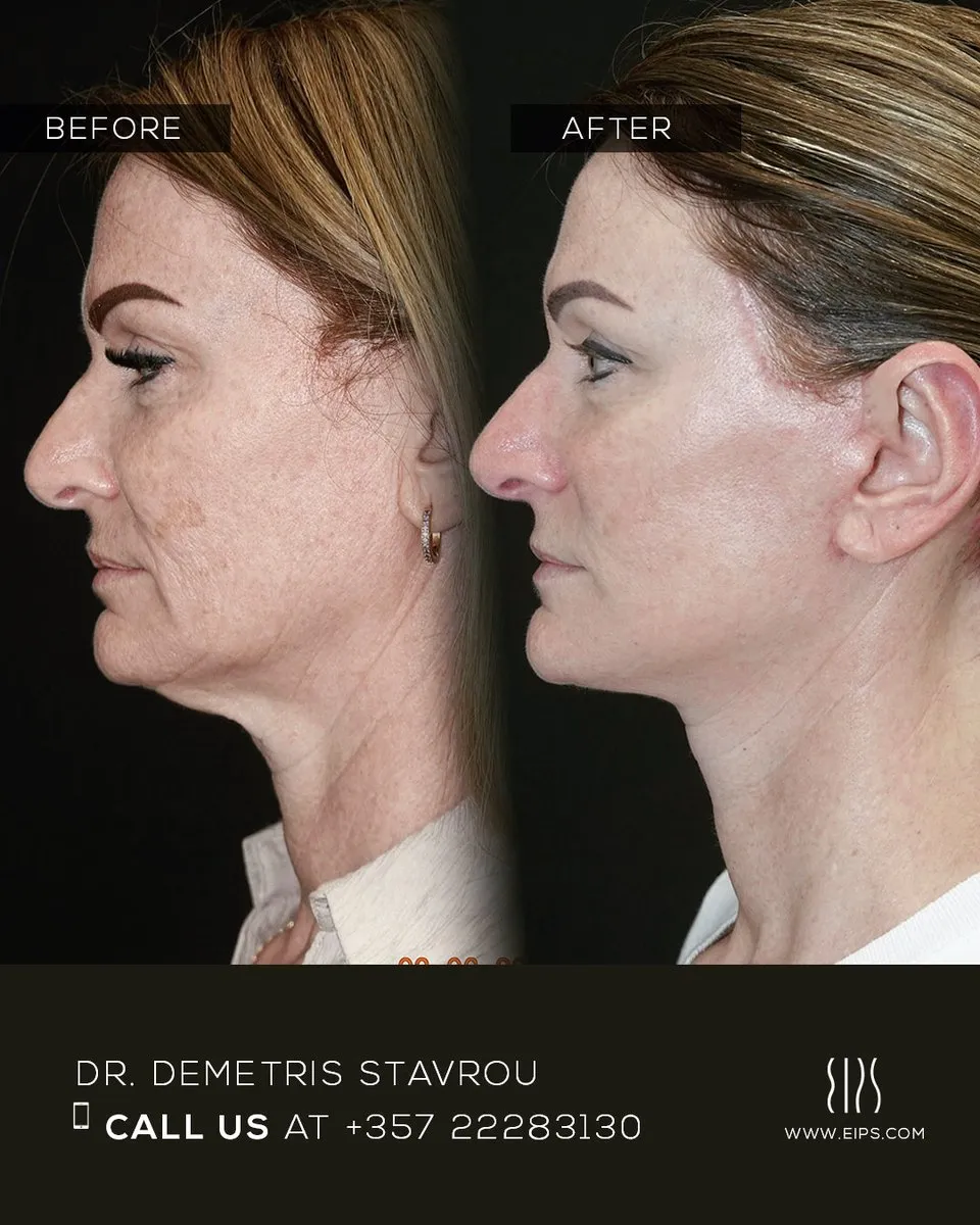Facelift before and after