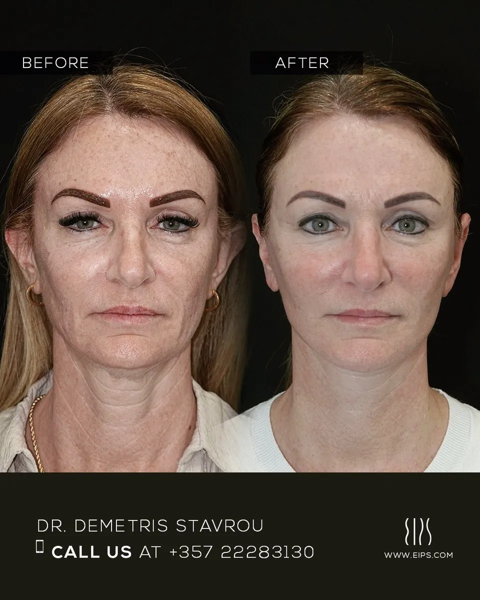 Facelift before and after