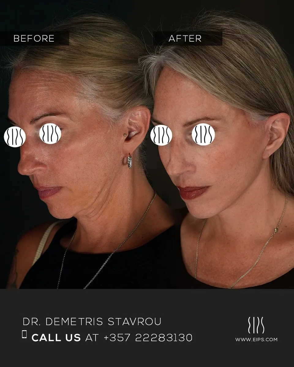 Facelift before and after