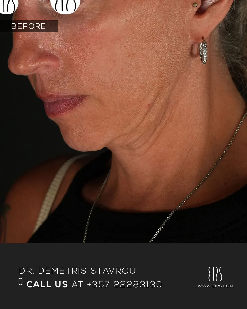 Facelift before and after