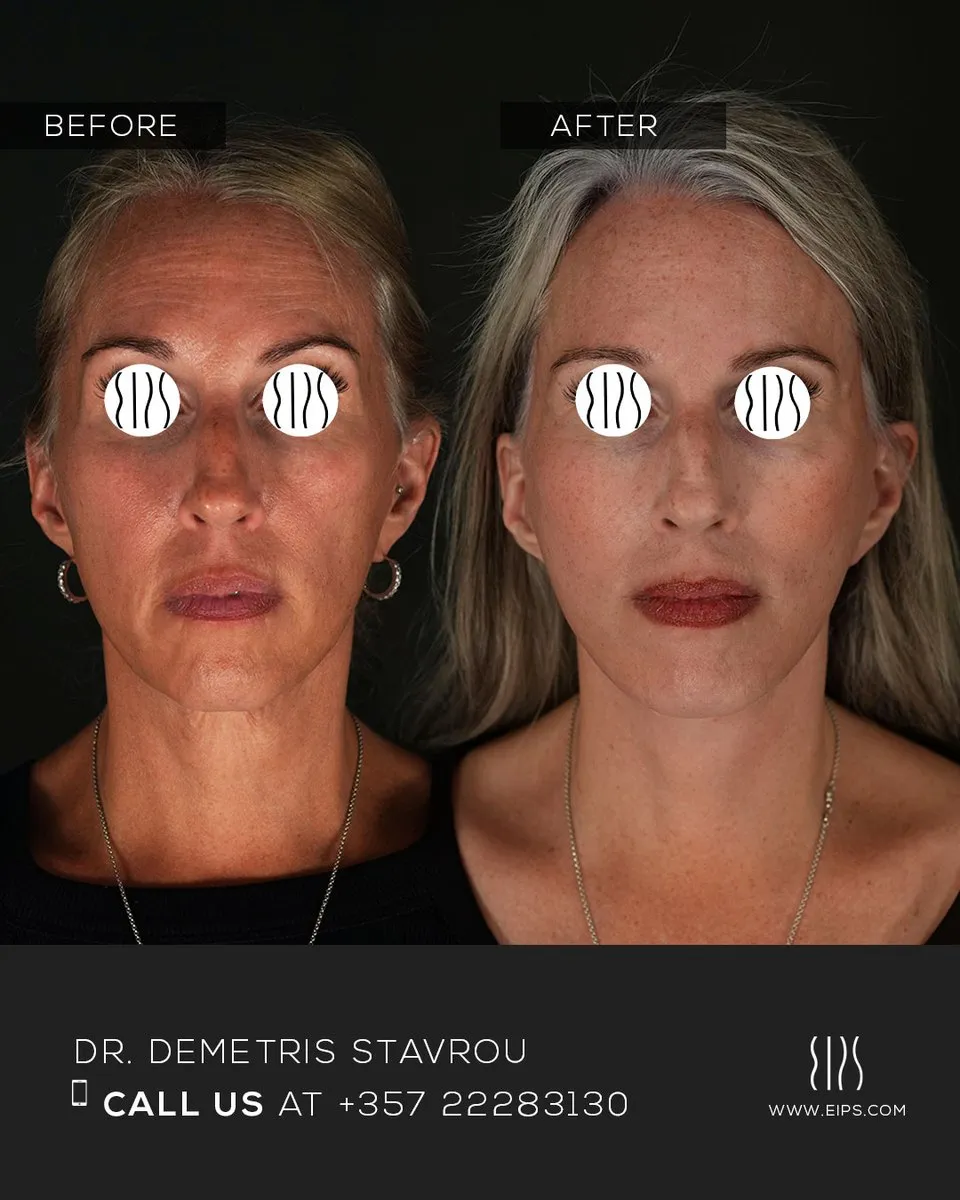 Facelift before and after