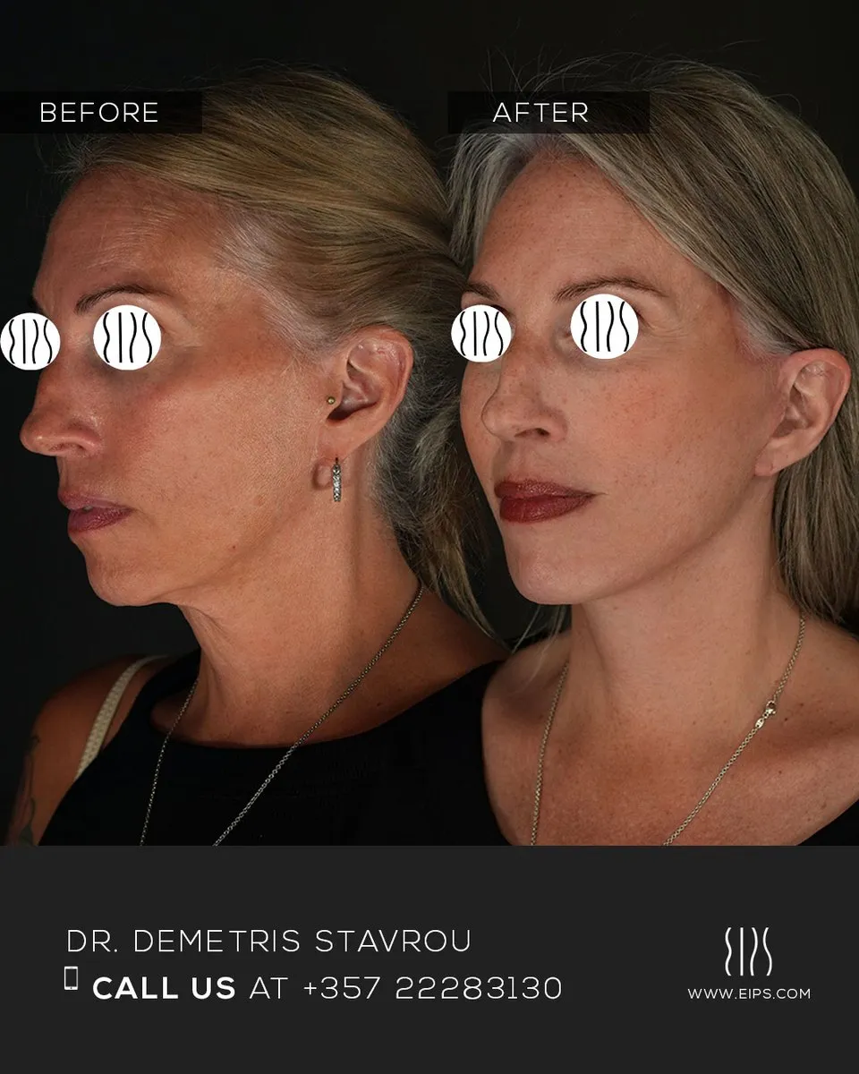 Facelift before and after