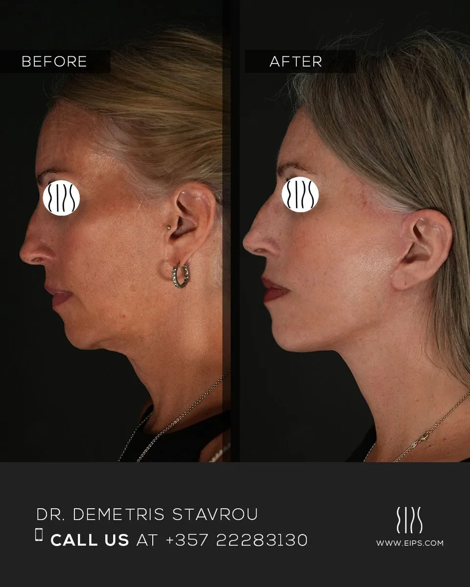 Facelift before and after