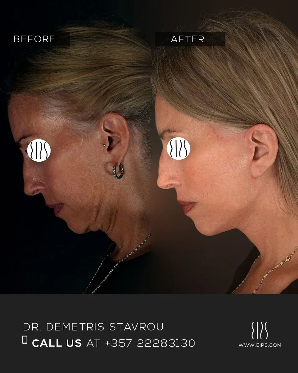 Facelift before and after