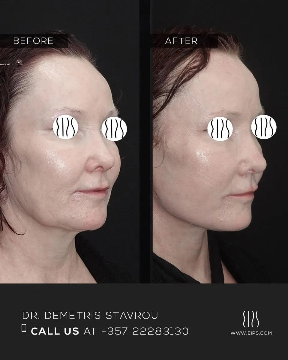 Facelift before and after