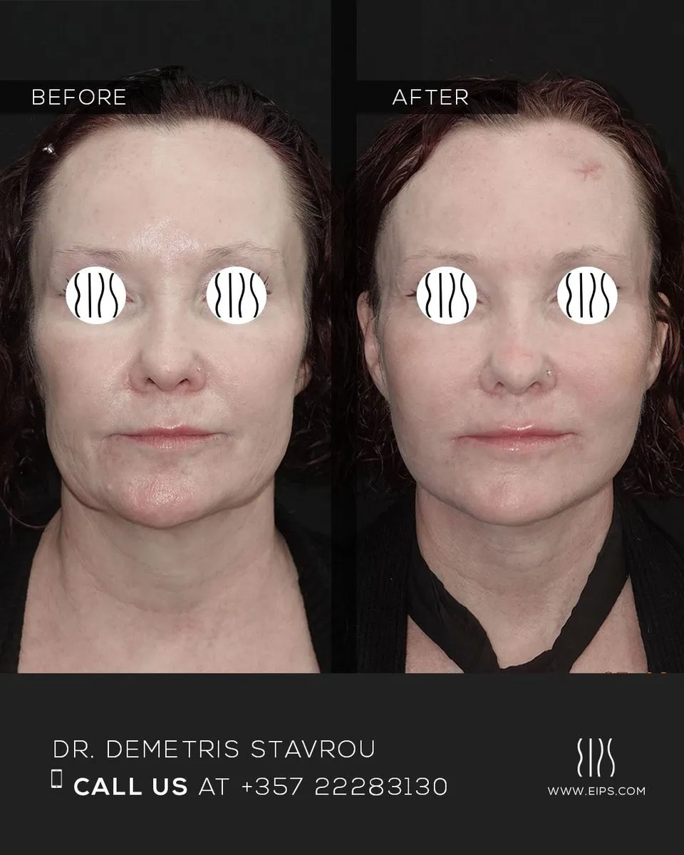 Facelift before and after