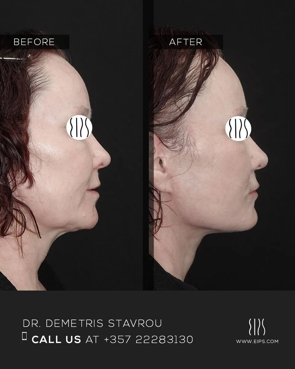Facelift before and after