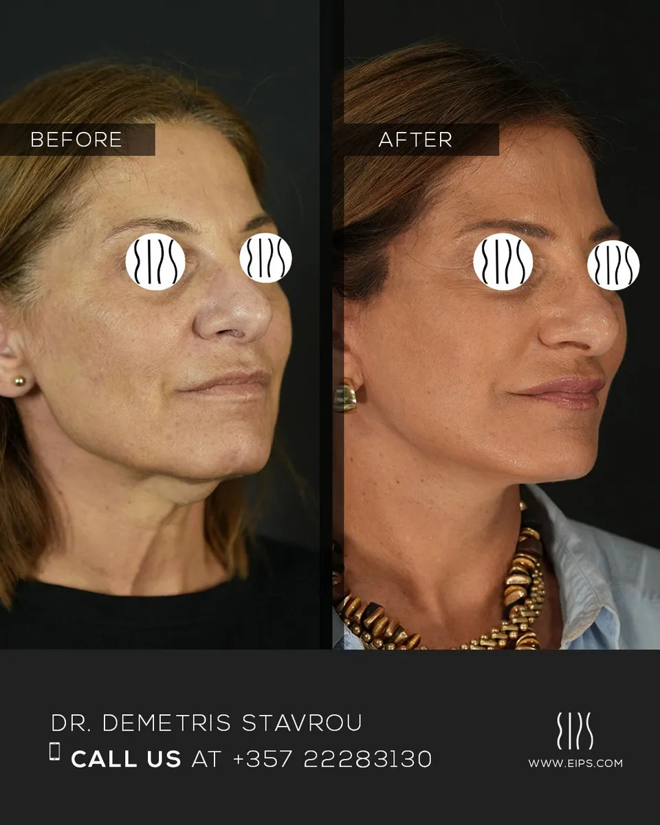 Facelift before and after