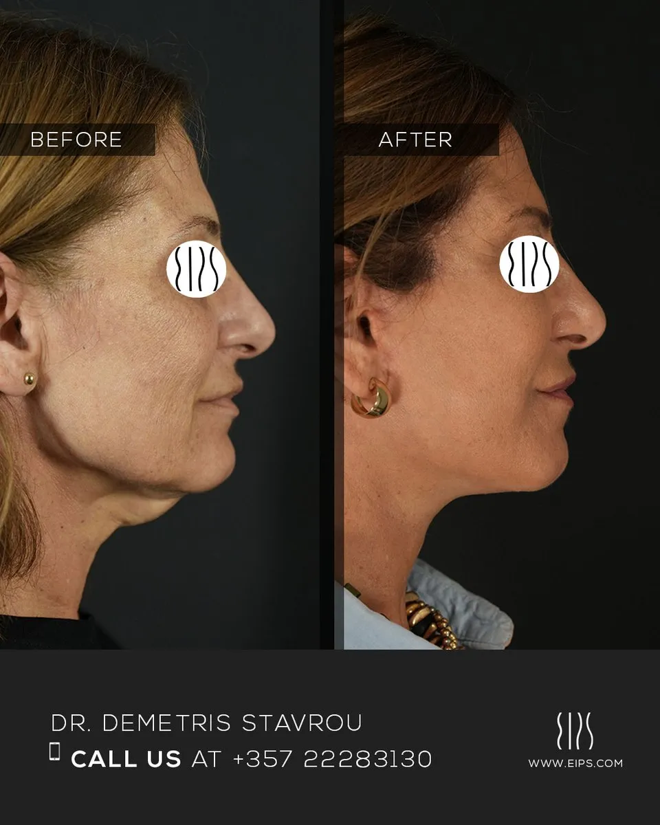 Facelift before and after