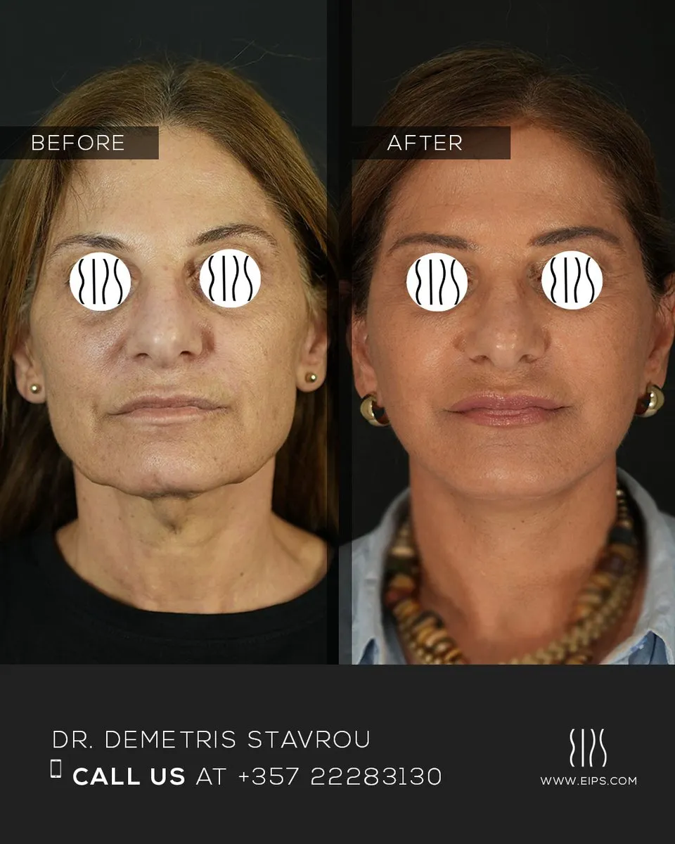 Facelift before and after