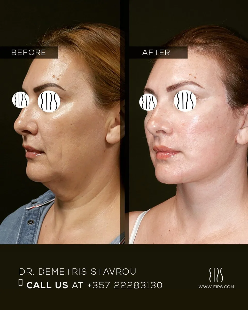 Facelift before and after