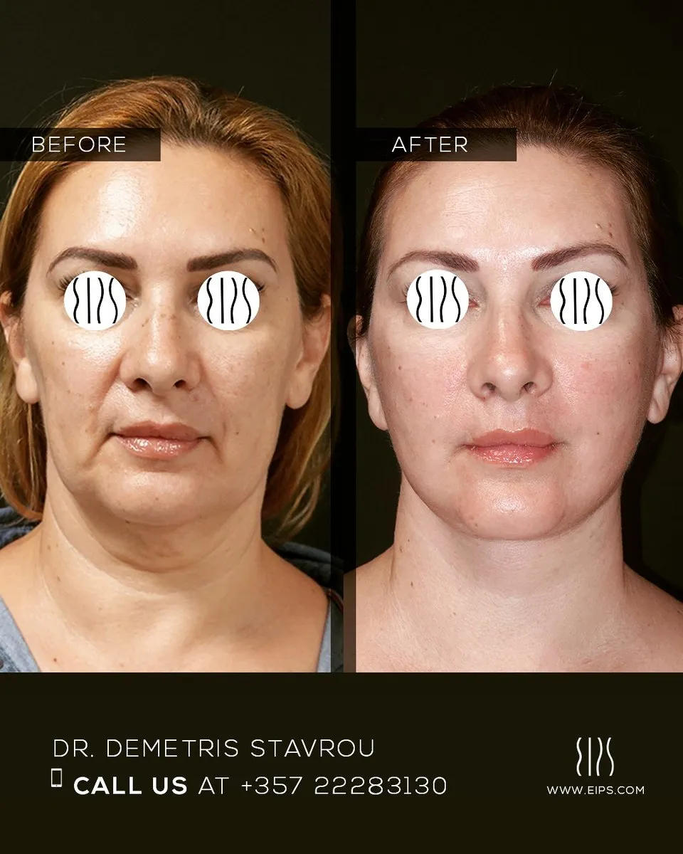Facelift before and after