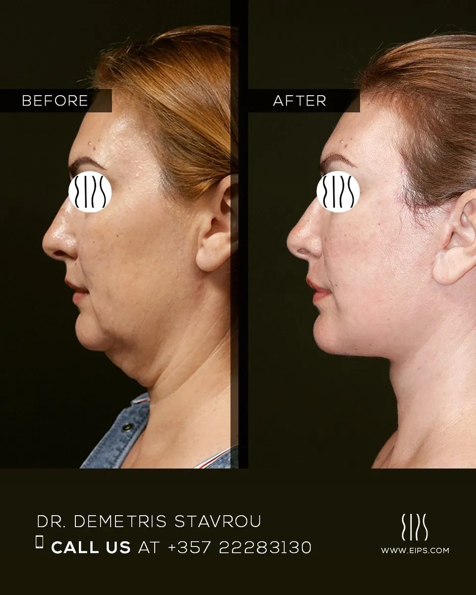 Facelift before and after