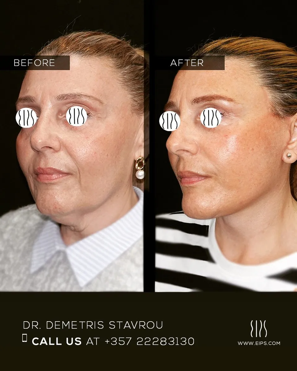 Facelift before and after