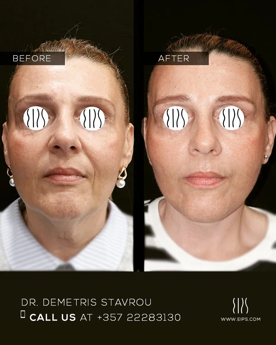 Facelift before and after