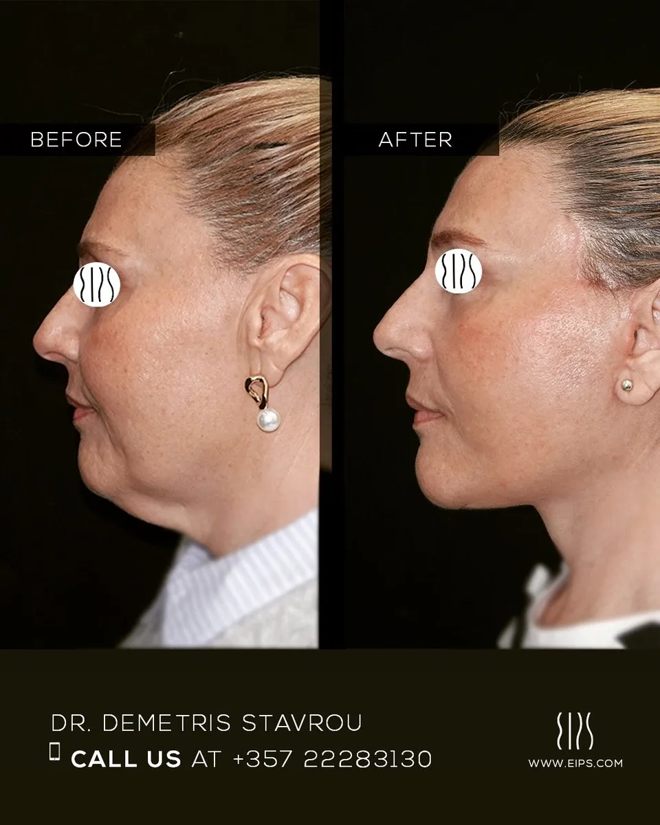 Facelift before and after