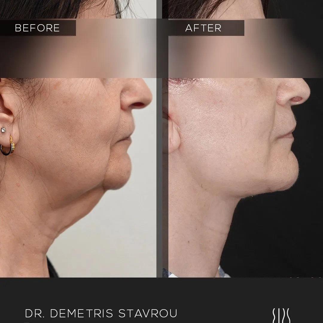 Facelift before and after