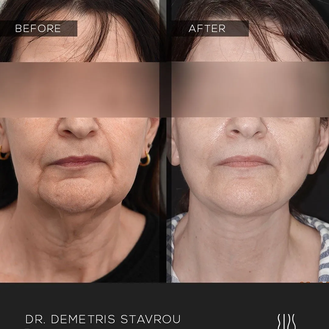 Facelift before and after