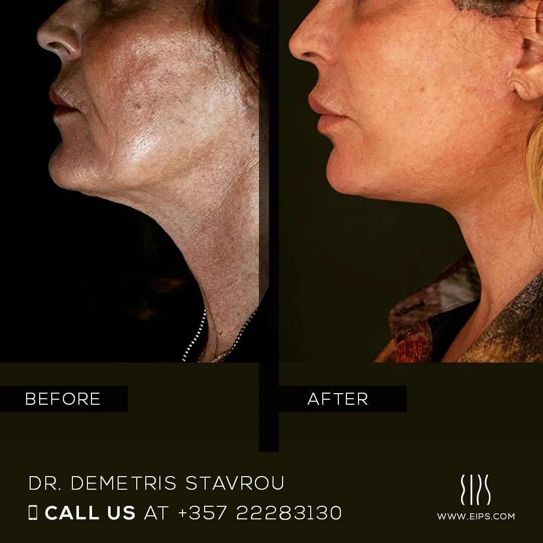 Facelift before and after