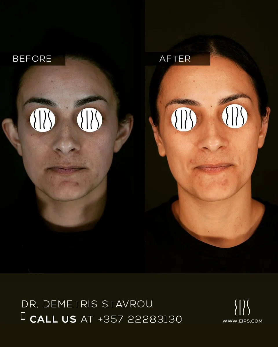 Otoplasty before and after