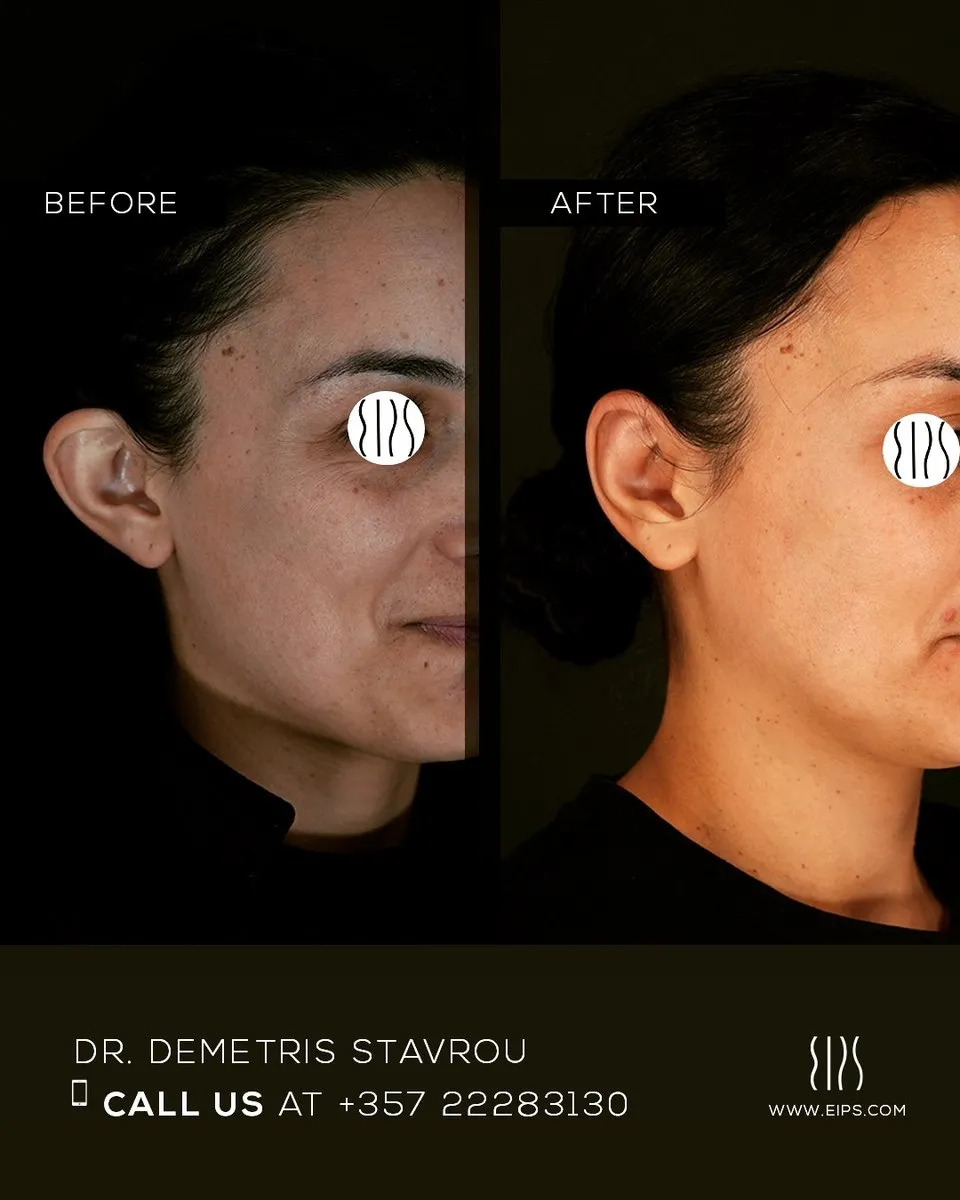 Otoplasty before and after