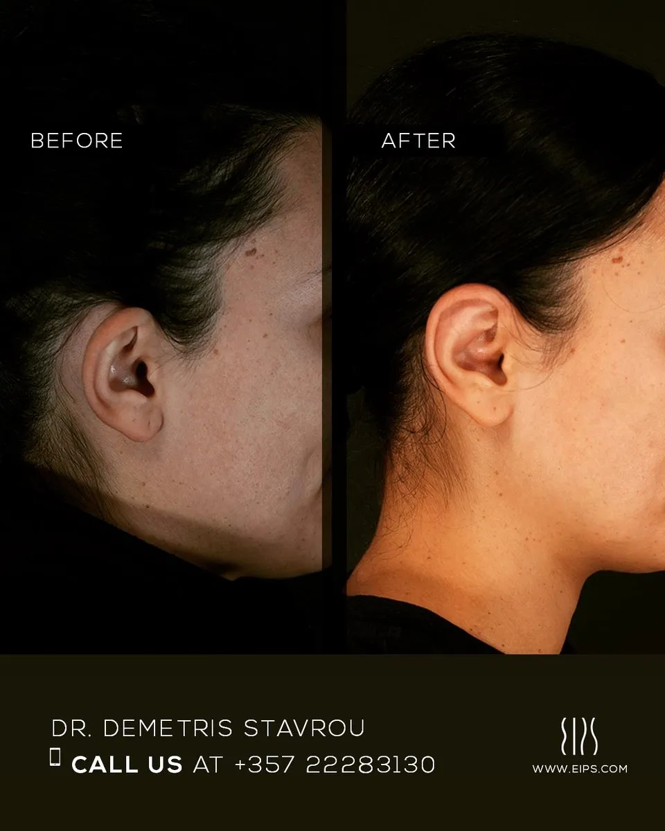 Otoplasty before and after