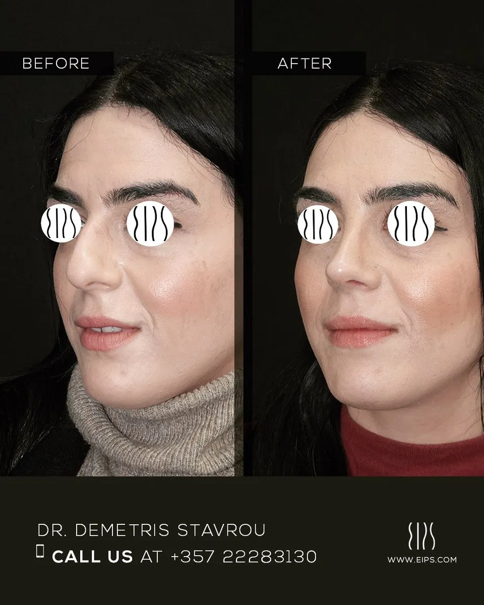 Rhinoplasty before and after