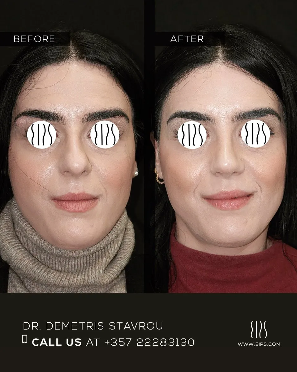 Rhinoplasty before and after