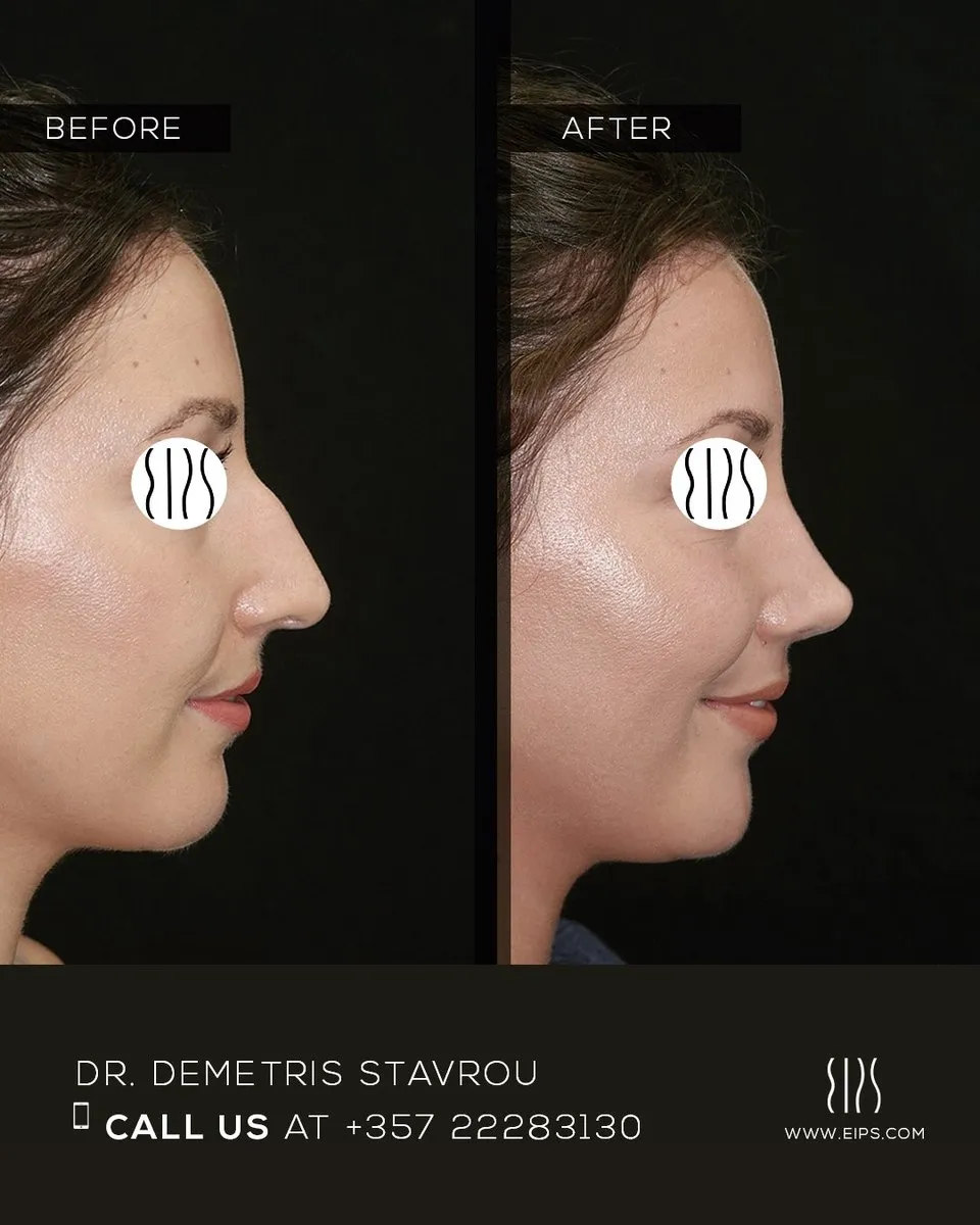Rhinoplasty before and after