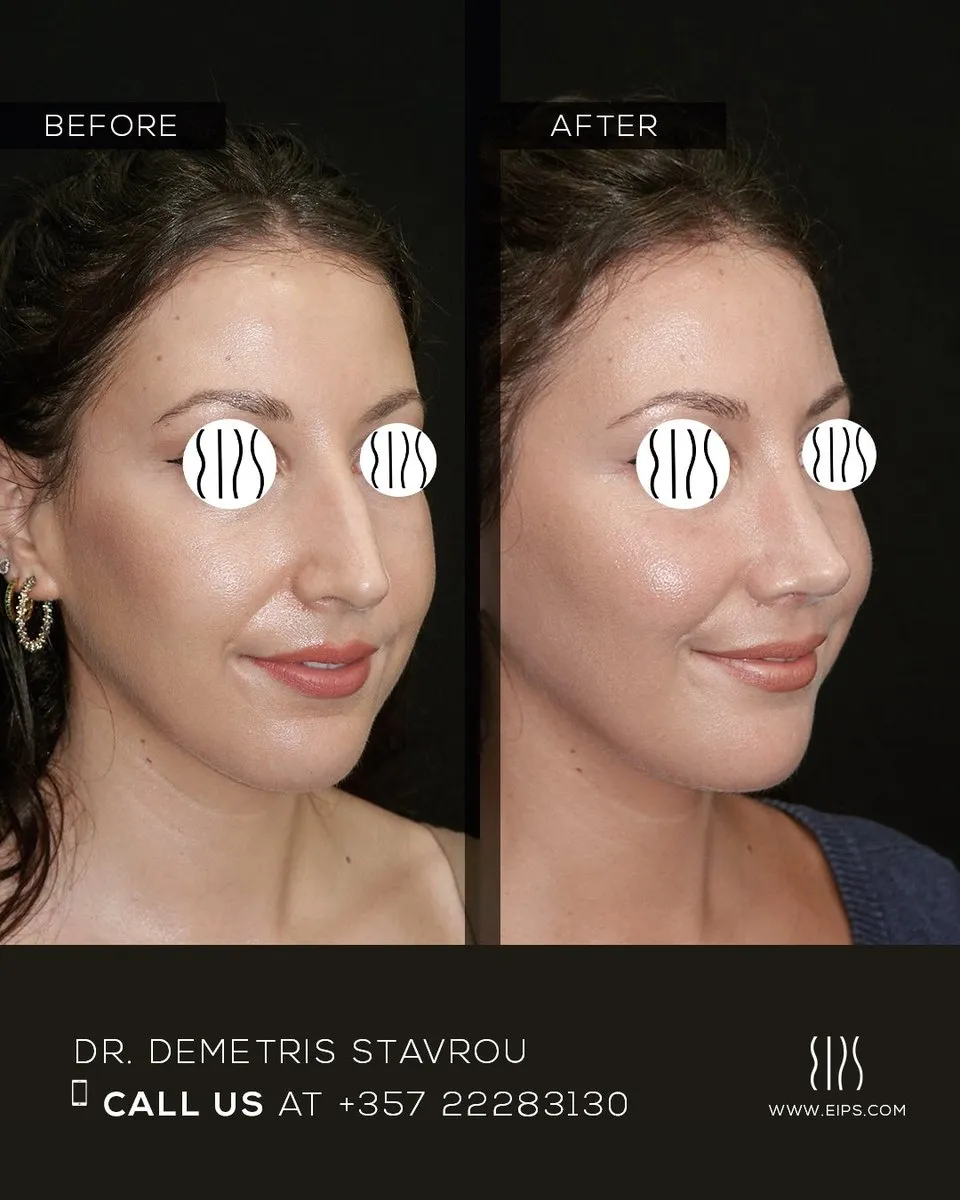 Rhinoplasty before and after