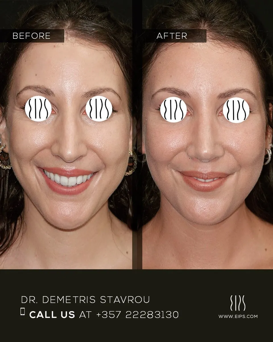 Rhinoplasty before and after
