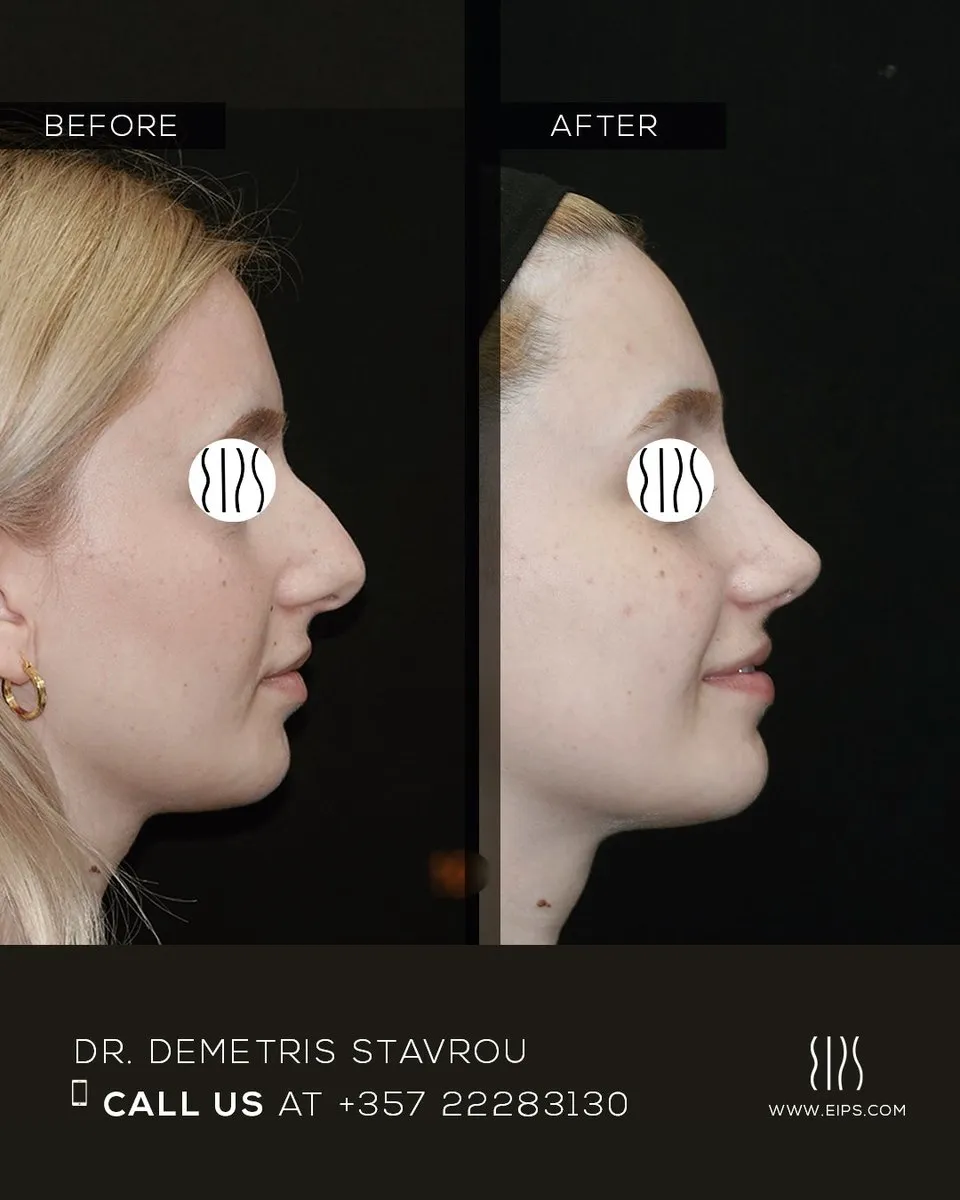 Rhinoplasty before and after