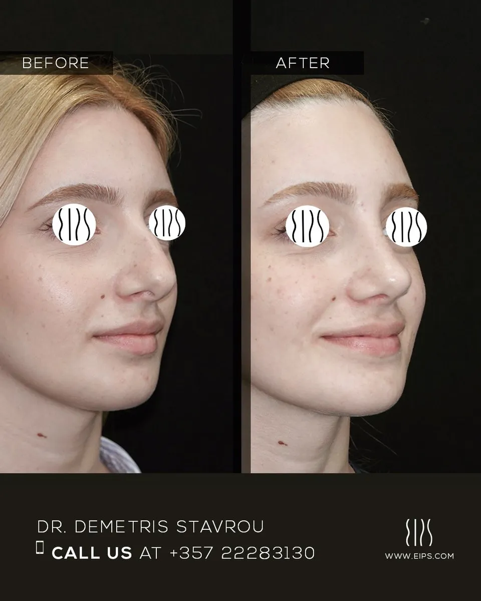 Rhinoplasty before and after