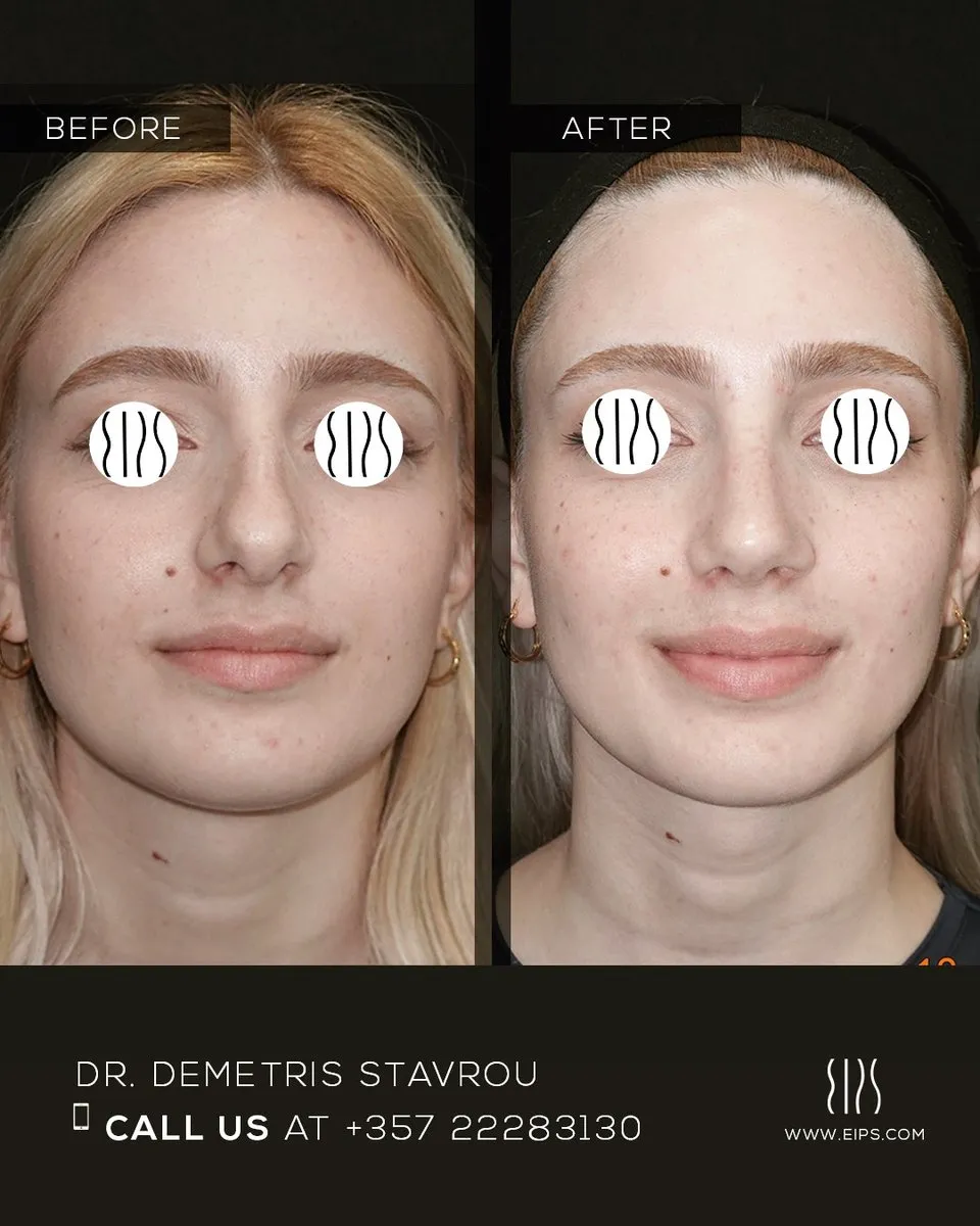 Rhinoplasty before and after