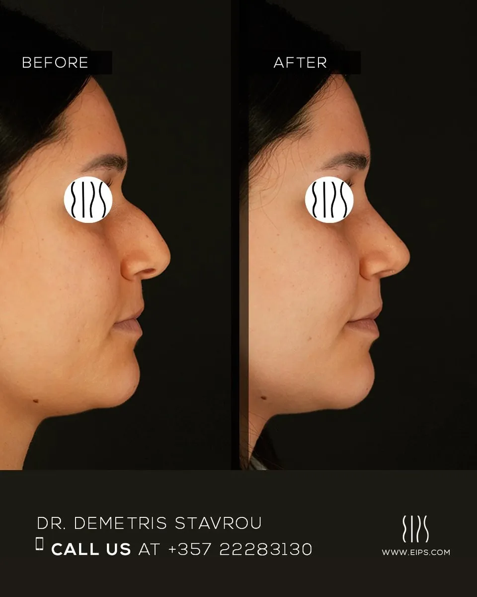 Rhinoplasty before and after
