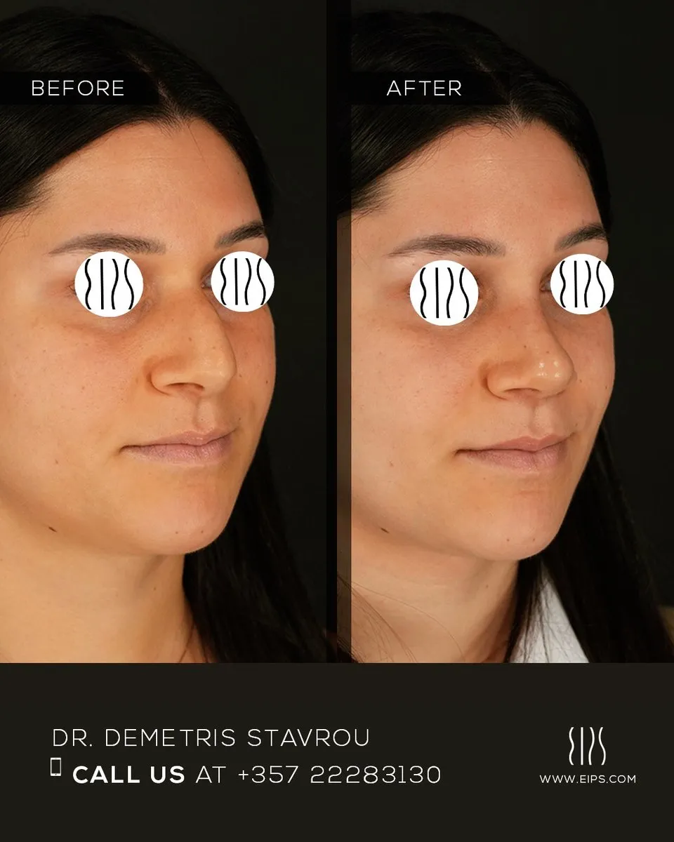Rhinoplasty before and after