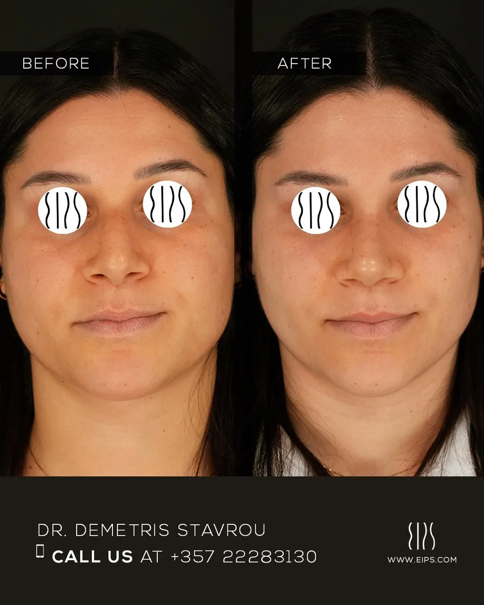 Rhinoplasty before and after