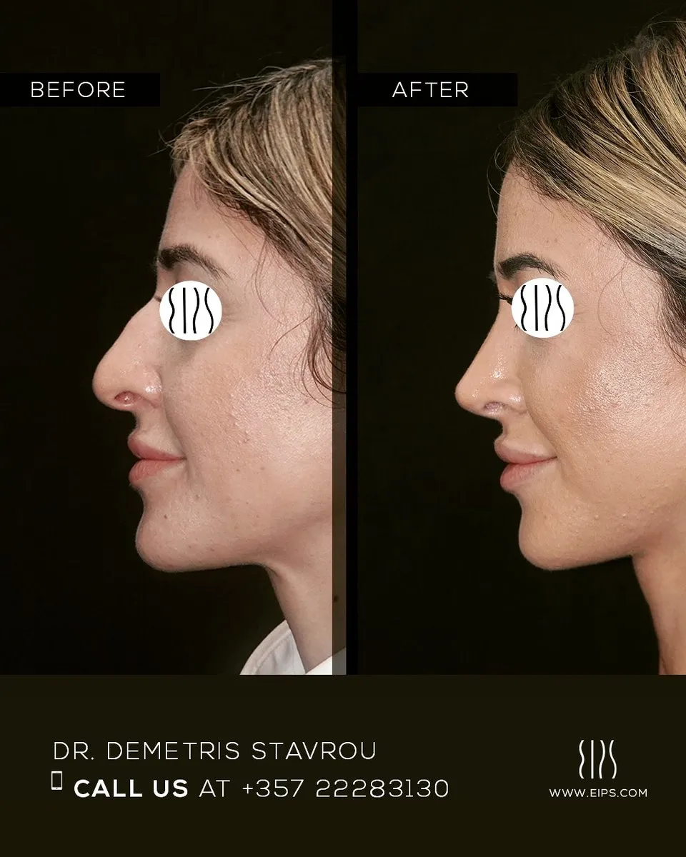 Rhinoplasty before and after